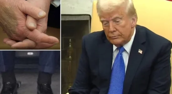 Me kyçet e këmbëve të fryra dhe duar të mavijosura, Shtëpia e Bardhë hedh dritë mbi shëndetin e Trump: Ai vuan nga…