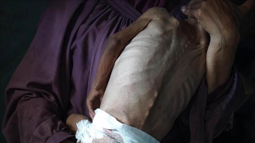 Gjashtë palestinezë të tjerë vdesin nga uria në Gaza gjatë 24 orëve të fundit, përfshirë një fëmijë